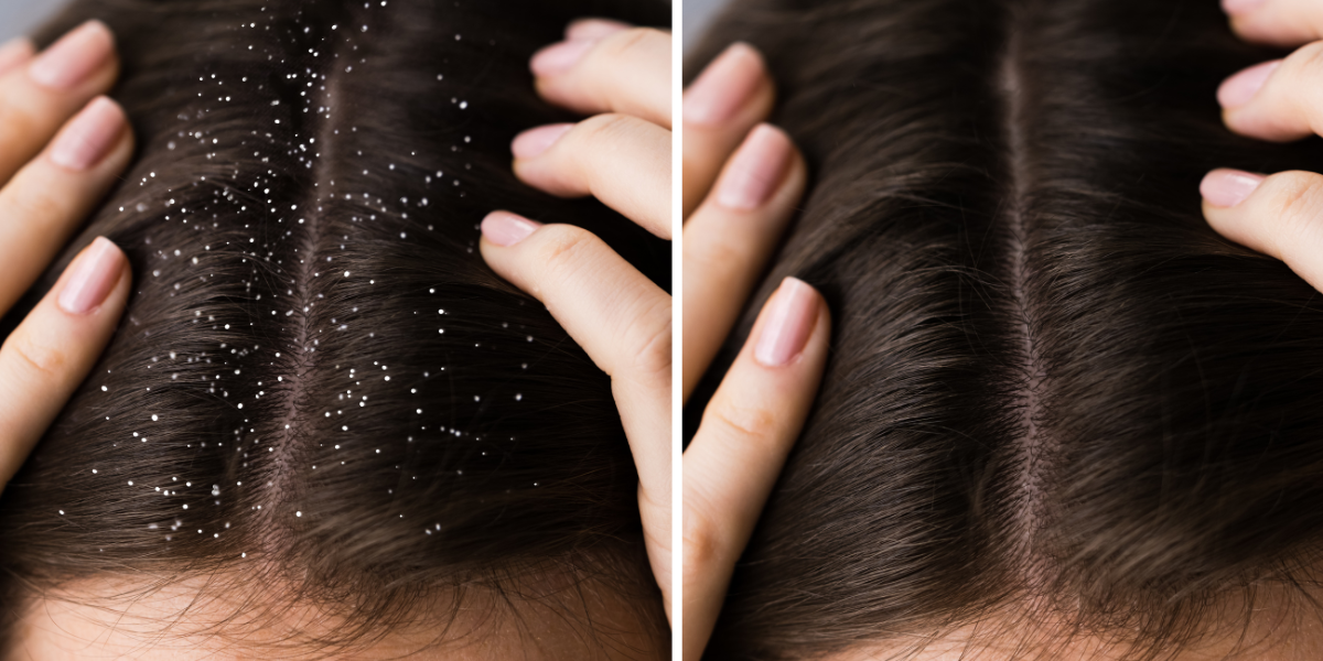 Cuoio capelluto con forfora visibile tra i capelli, esempio di condizione da trattare
