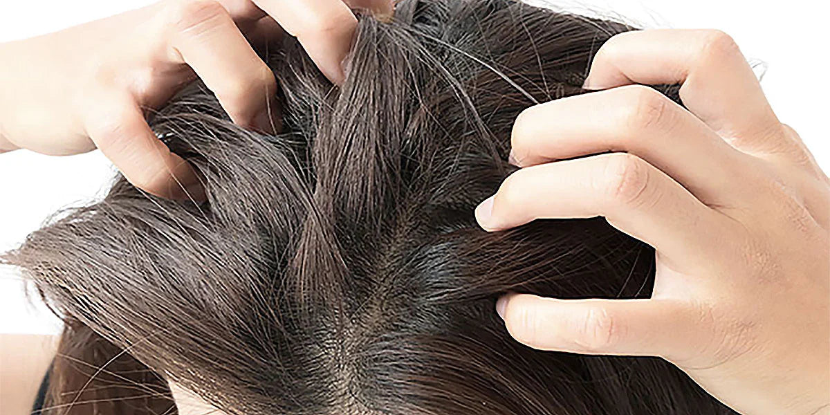 Cuoio capelluto con segni di forfora e irritazione cutanea