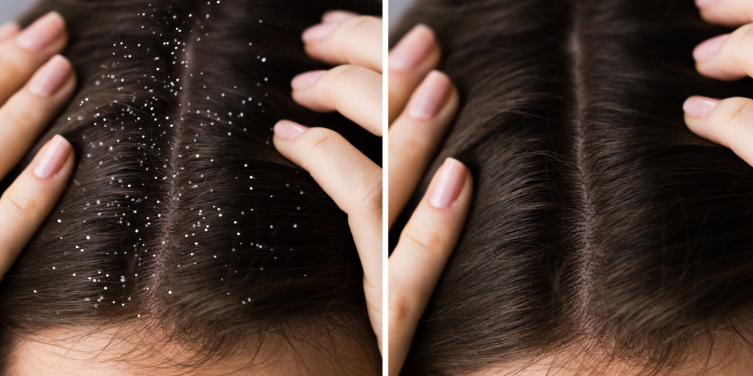 Forfora sui capelli: cause, rimedi e prodotti consigliati