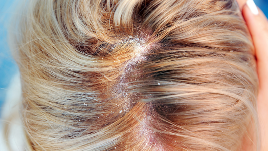 Dermatite Seborroica: cos'è, cause e come trattarla
