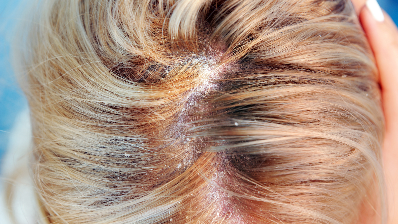 Cuoio capelluto con segni di dermatite seborroica e desquamazione