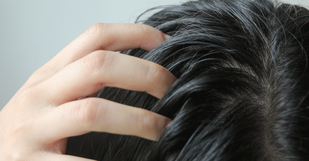 Cuoio capelluto grasso con capelli che si ungono subito dopo il lavaggio